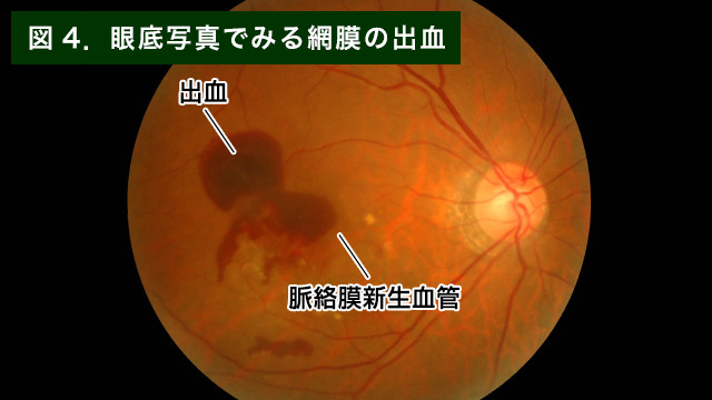 【画像】網膜の出血写真