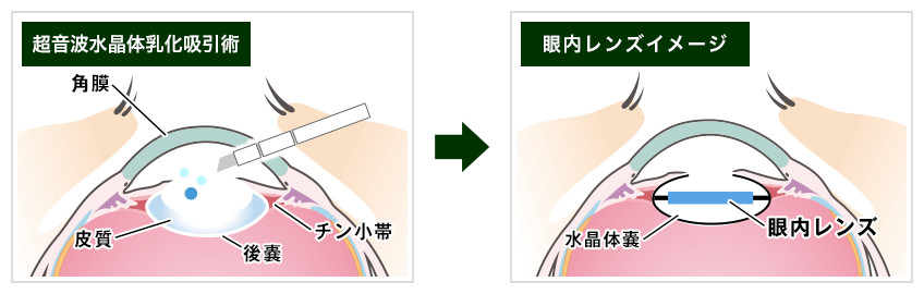 【画像】白内障の手術イメージ