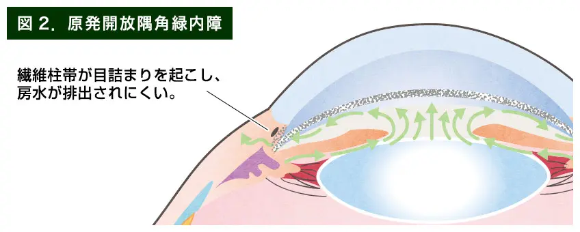 All About 開放隅角緑内障 All About 開放隅角緑内障 第2版 | 書籍詳細 | 書籍 | 医学書院